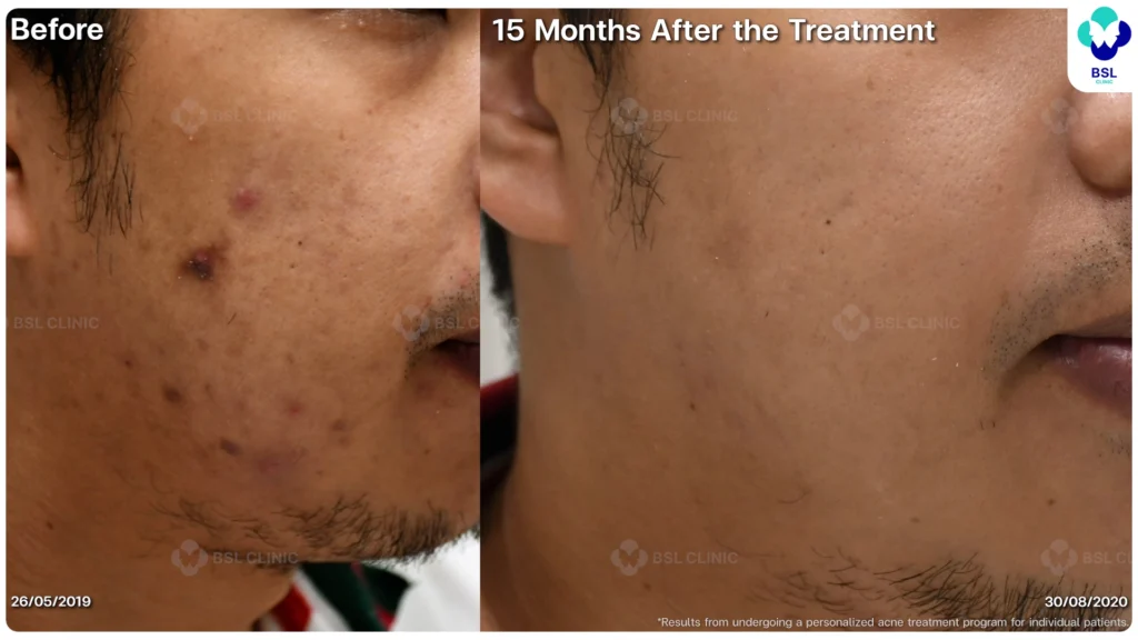 รีวิวรักษาสิว