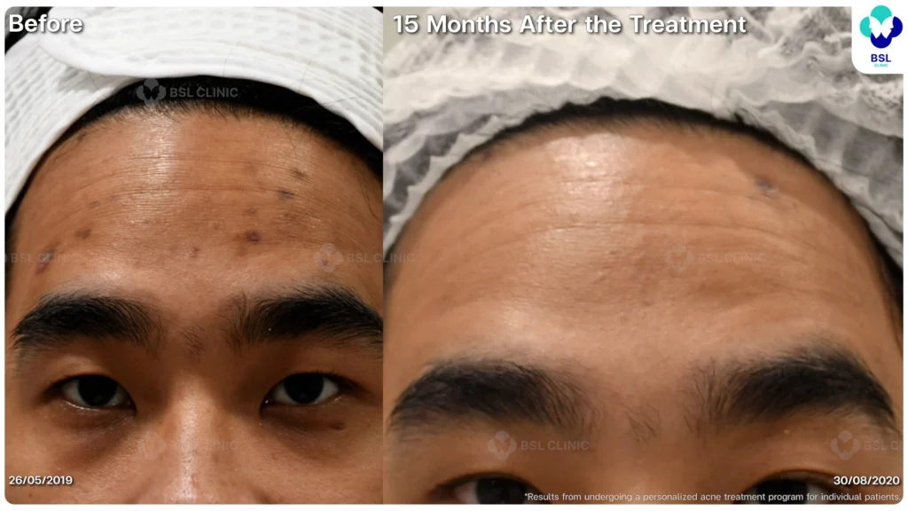 รีวิวรักษาสิว