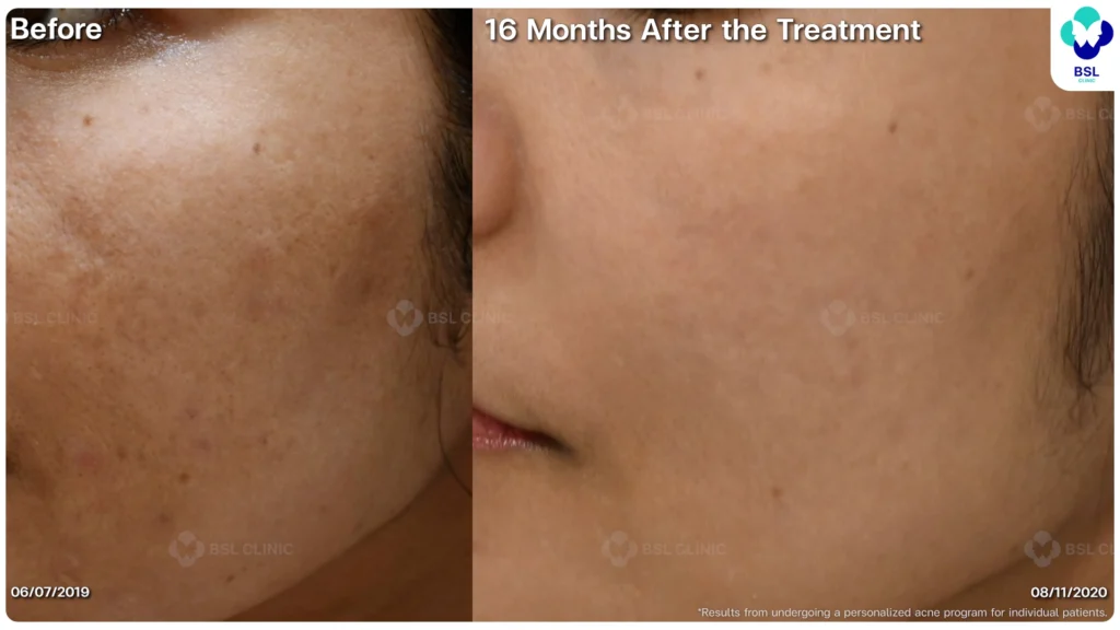 รีวิวรักษาสิว