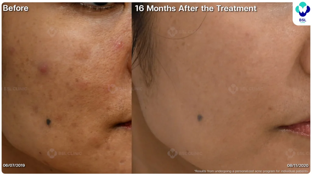 รีวิวรักษาสิว