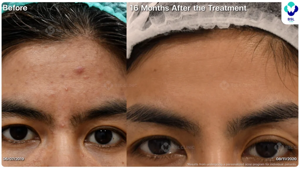 รีวิวรักษาสิว