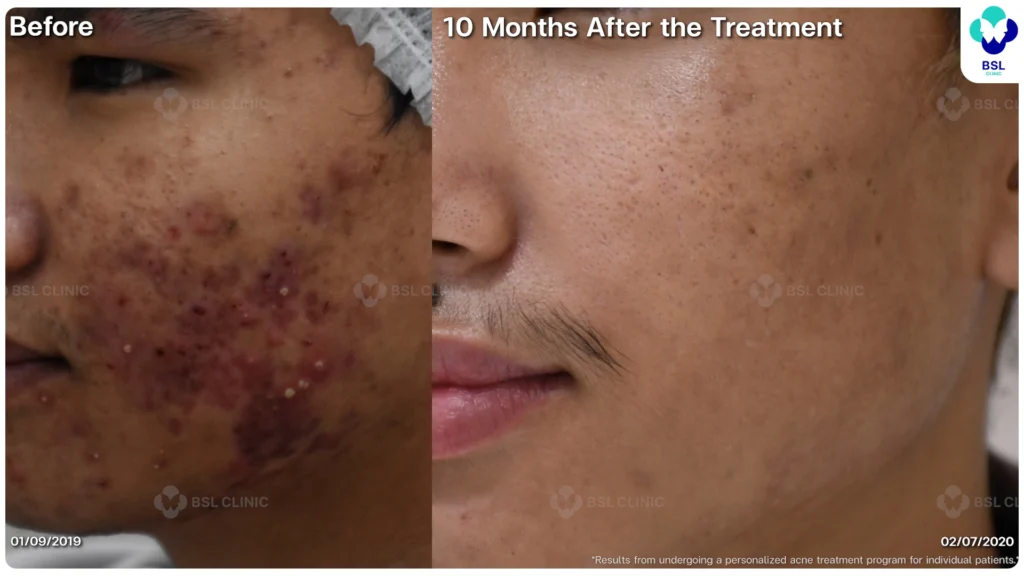 รีวิวรักษาสิว