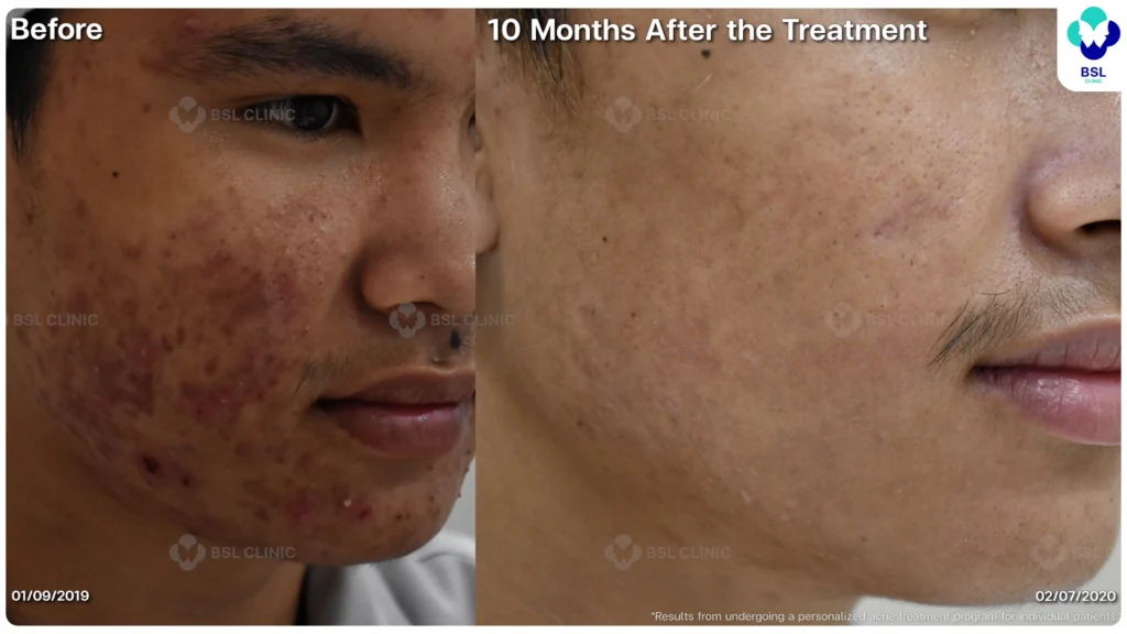 รีวิวรักษาสิว