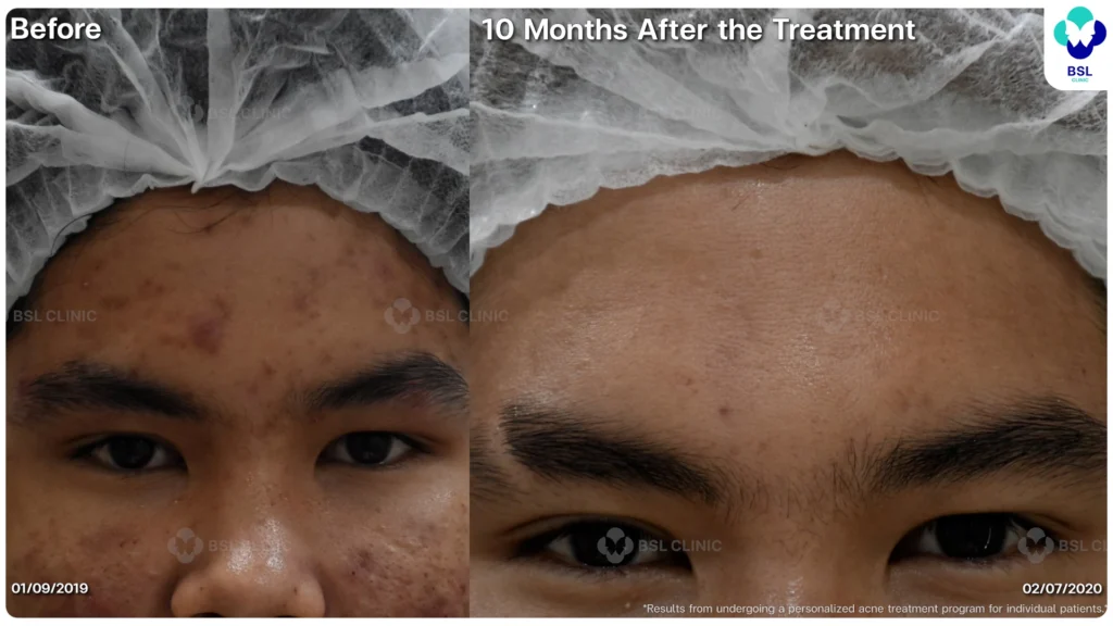 รีวิวรักษาสิว