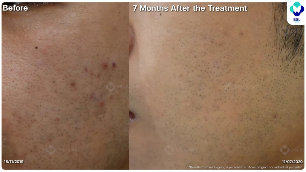 รีวิวรักษาสิว