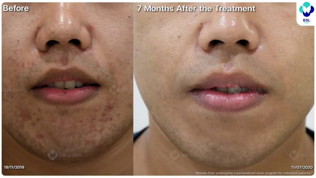 รีวิวรักษาสิว