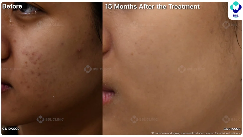 รีวิวรักษาสิว หนุ่มใต้