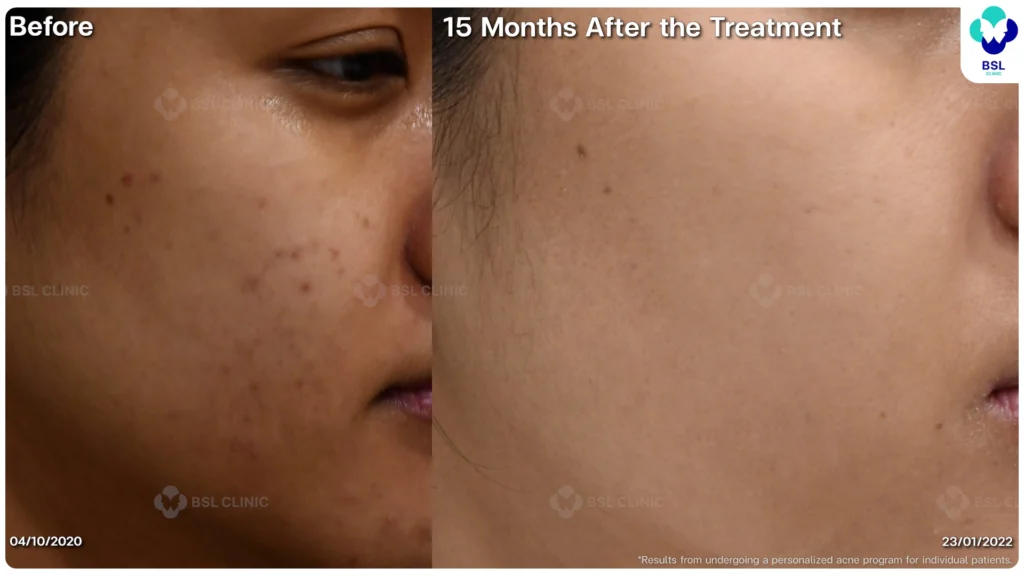 รีวิวรักษาสิว หนุ่มใต้