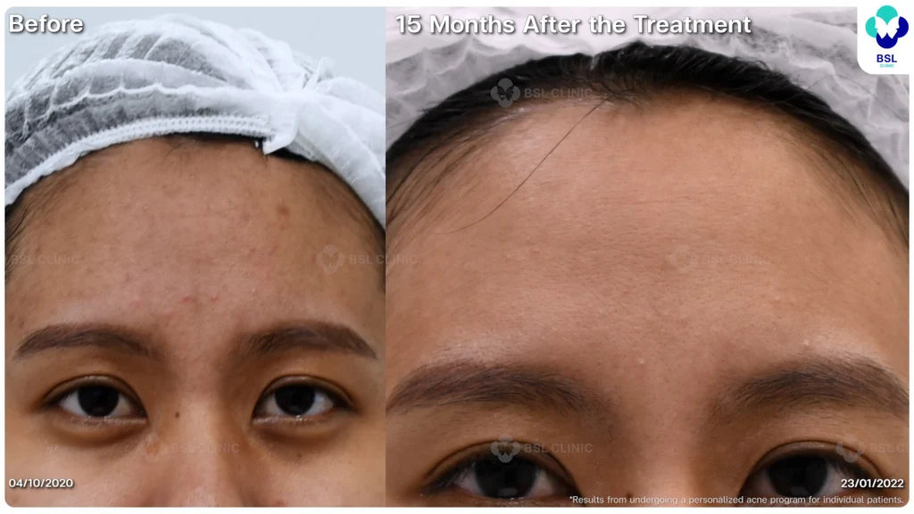 รีวิวรักษาสิว หนุ่มใต้