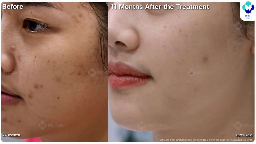 รีวิวรักษาสิว