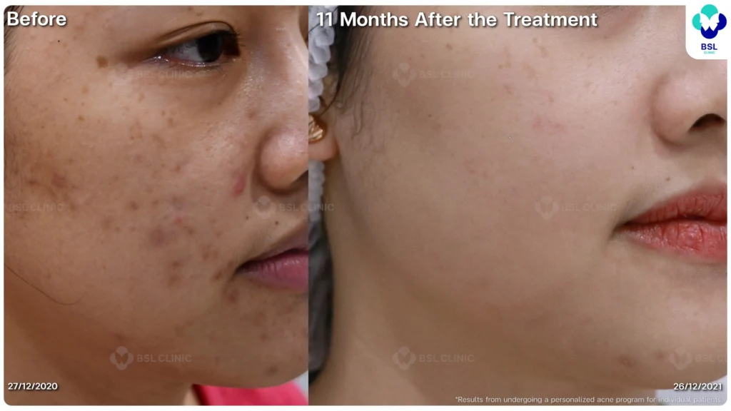 รีวิวรักษาสิว