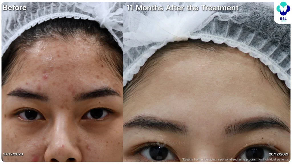 รีวิวรักษาสิว