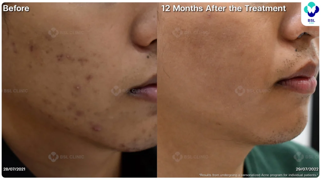 รีวิวรักษาสิว