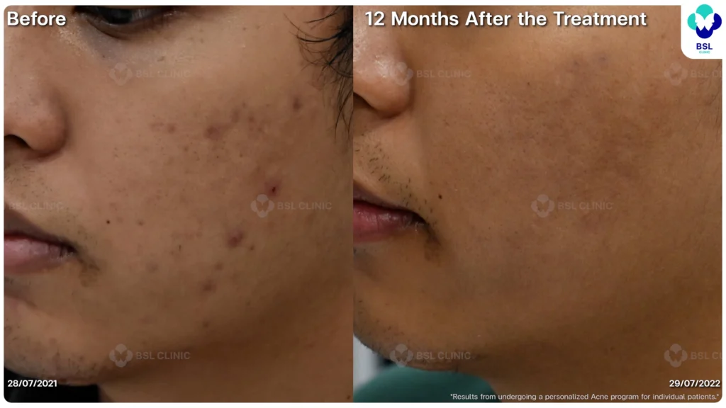 รีวิวรักษาสิว