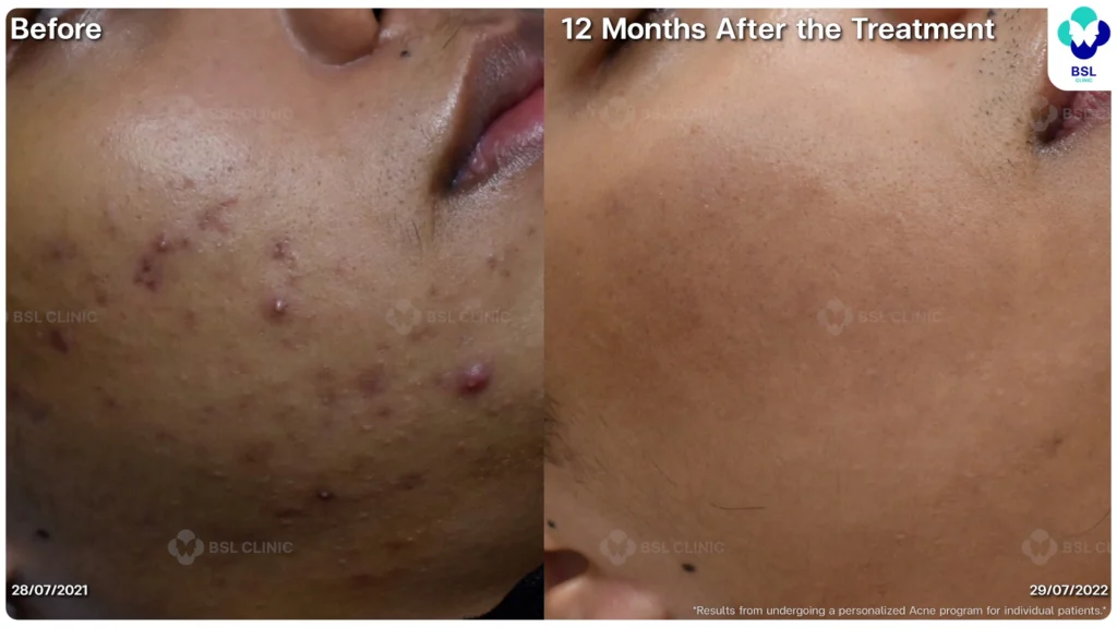 รีวิวรักษาสิว