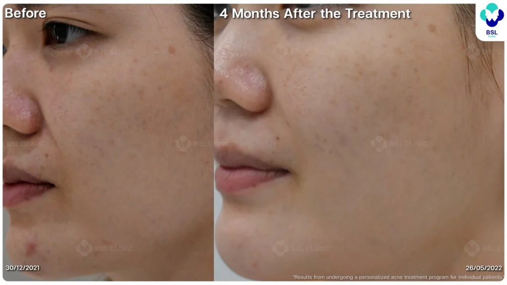 รีวิวรักษาสิว