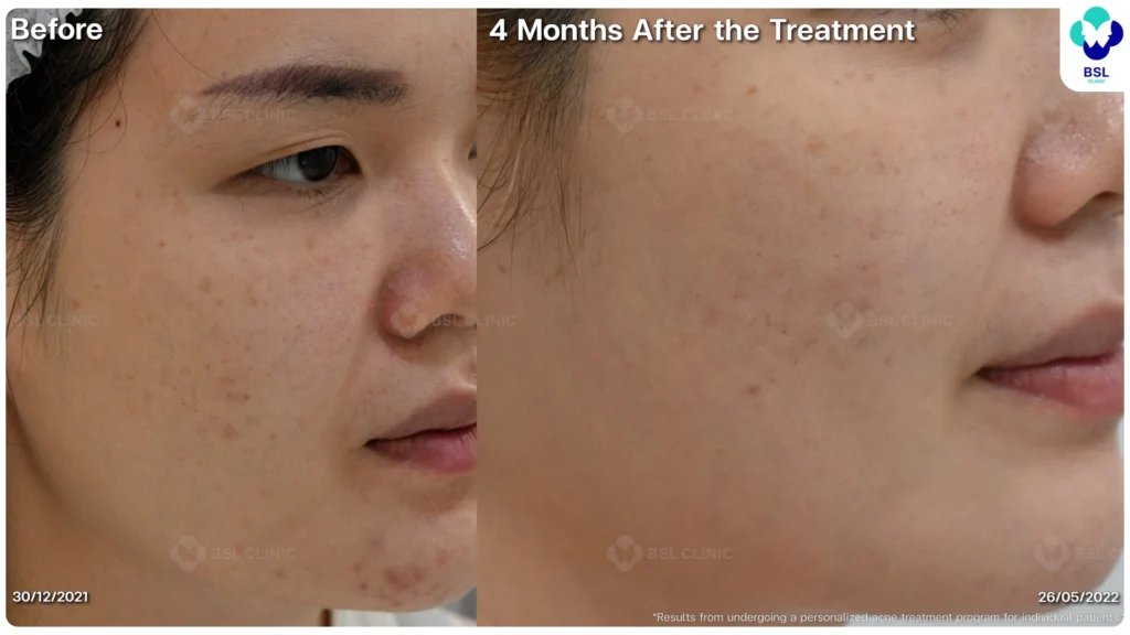 รีวิวรักษาสิว