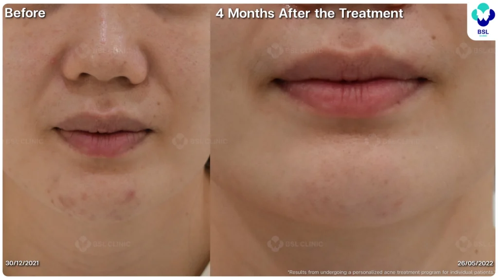 รีวิวรักษาสิว