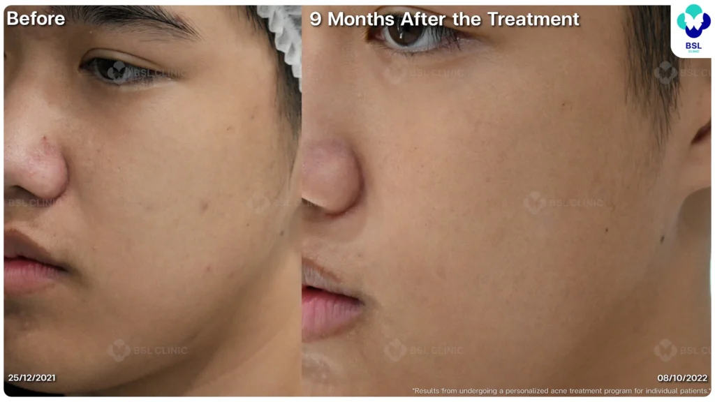 รีวิวรักษาสิวฮอร์โมน