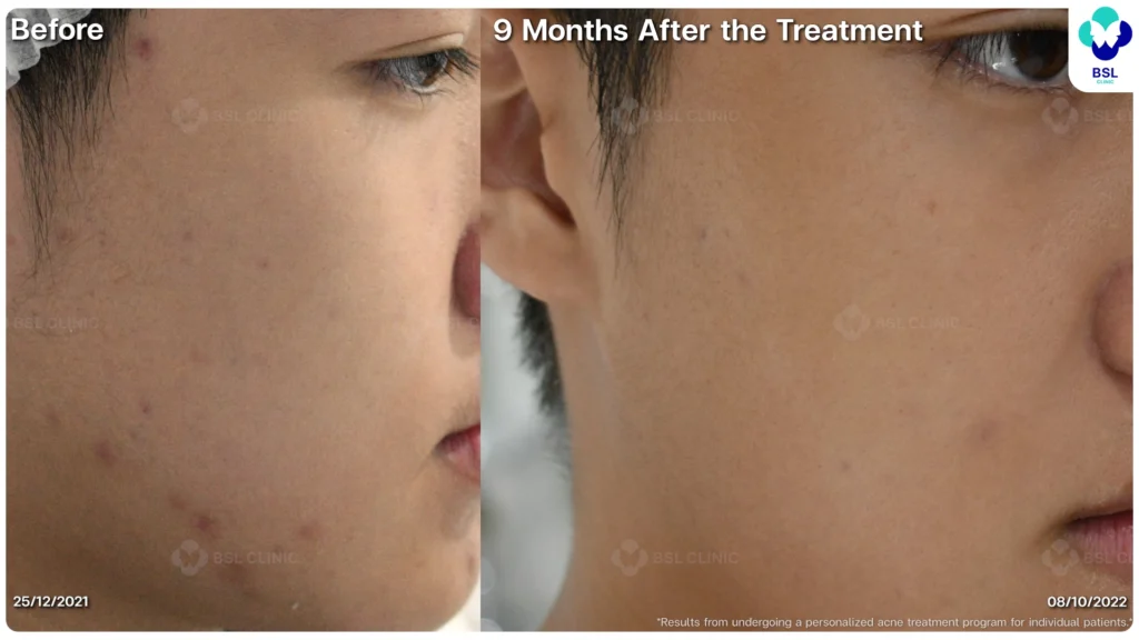 รีวิวรักษาสิวฮอร์โมน