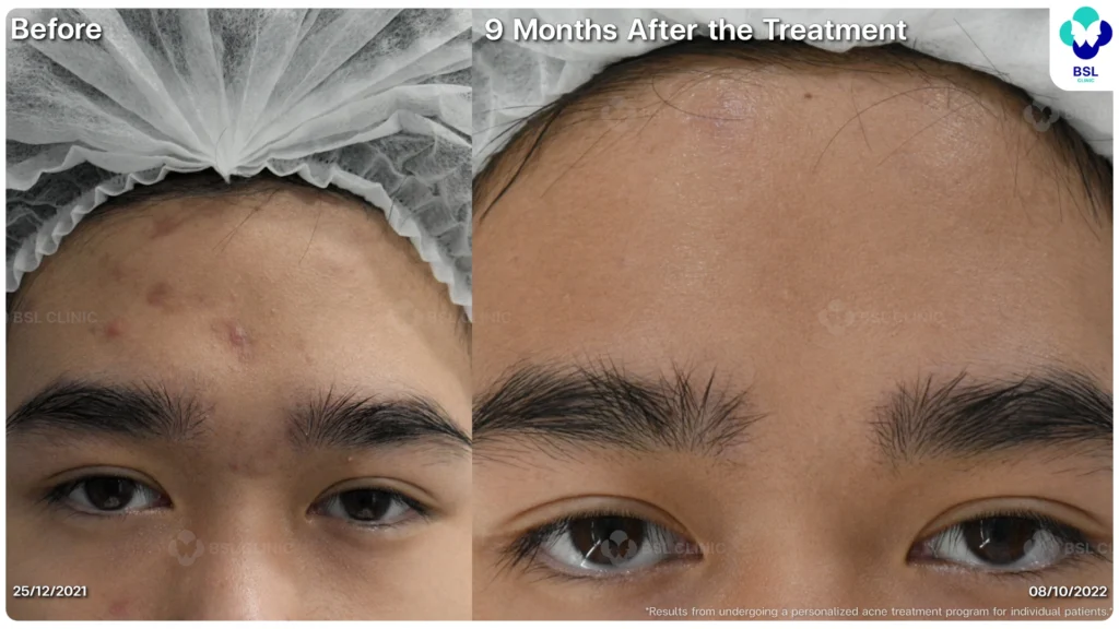 รีวิวรักษาสิวฮอร์โมน