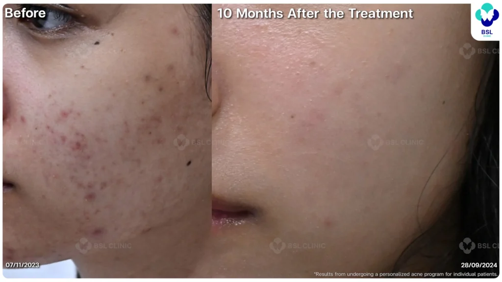 รีวิวรักษาสิว