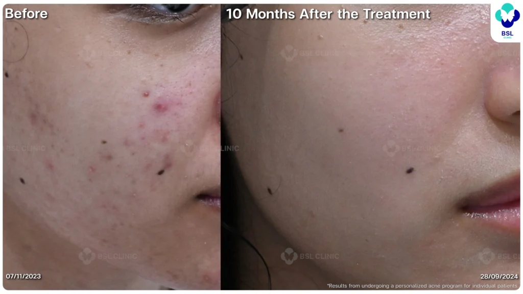 รีวิวรักษาสิว