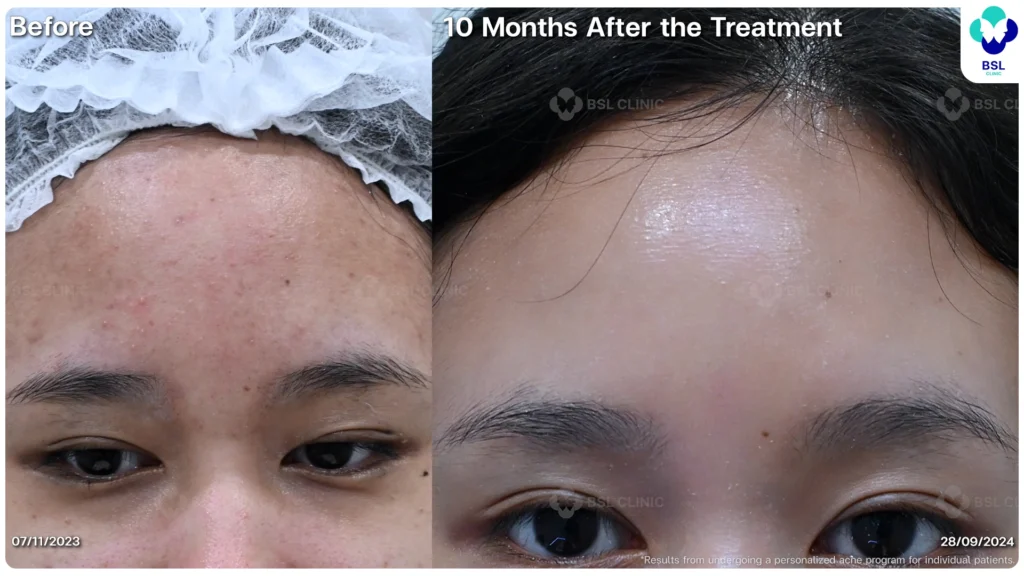 รีวิวรักษาสิว