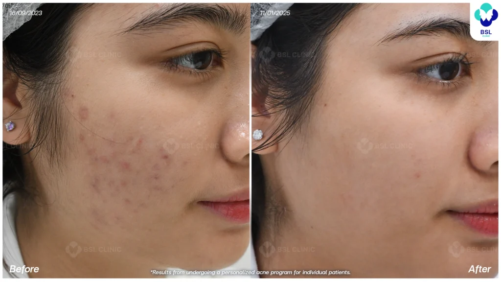 รีวิวรักษาสิว bsl clinic