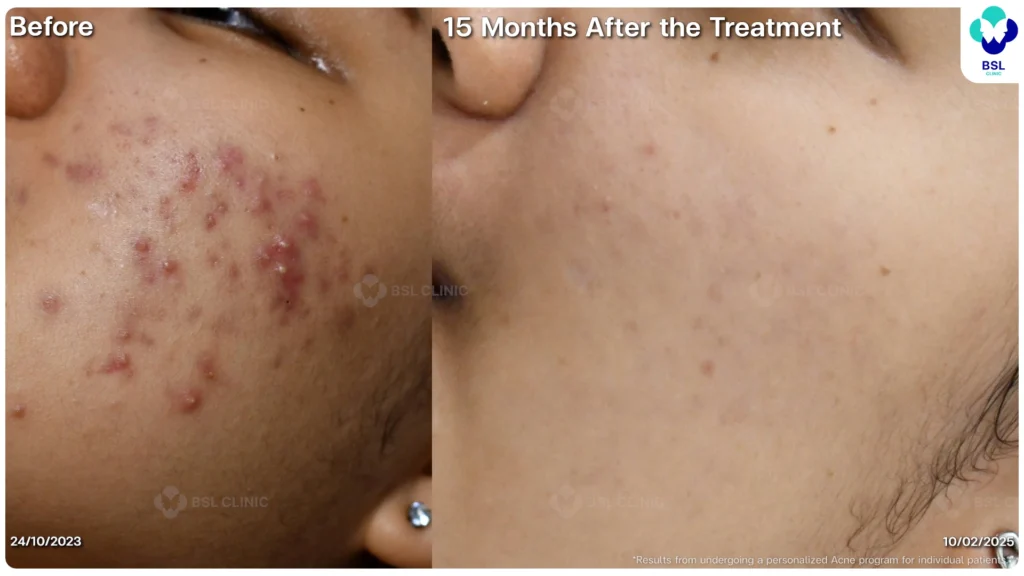 รีวิวรักษาสิว