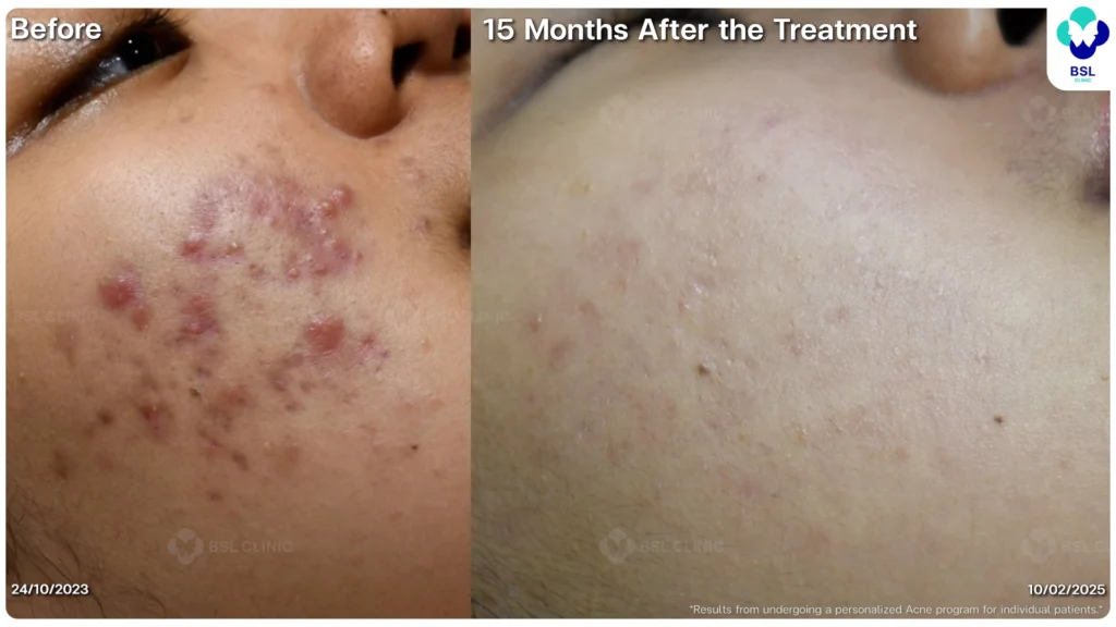 รีวิวรักษาสิว