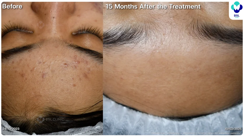 รีวิวรักษาสิว