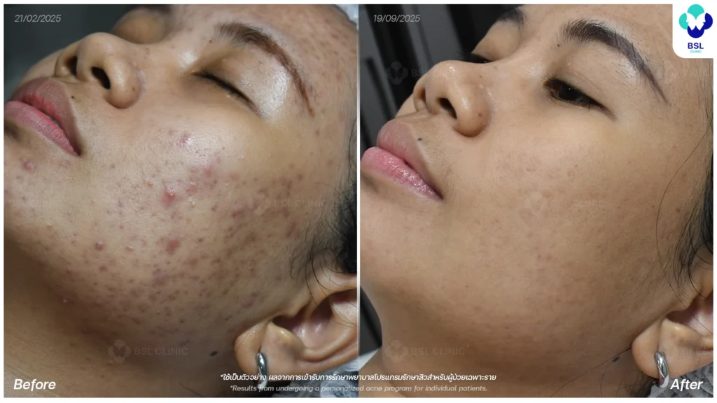 การดูแลผิว ผลการรักษาสิว