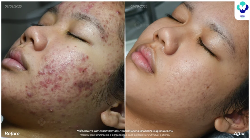 การดูแลผิว รีวิวผลการรักษาสิว