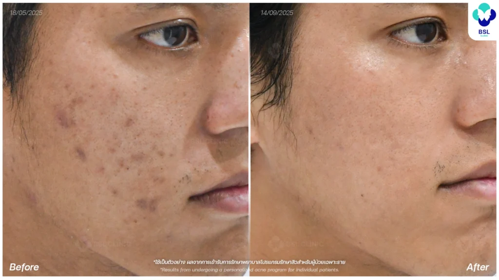 การดูแลผิว รีวิวผลการรักษาสิว