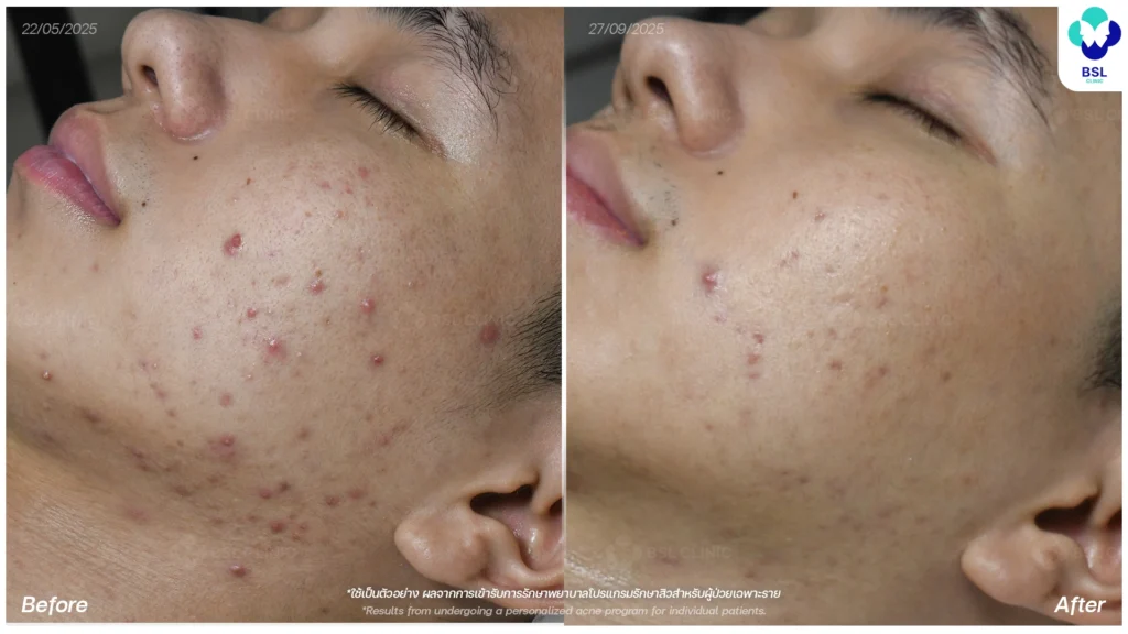 การดูแลผิว รีวิวผลการรักษาสิว