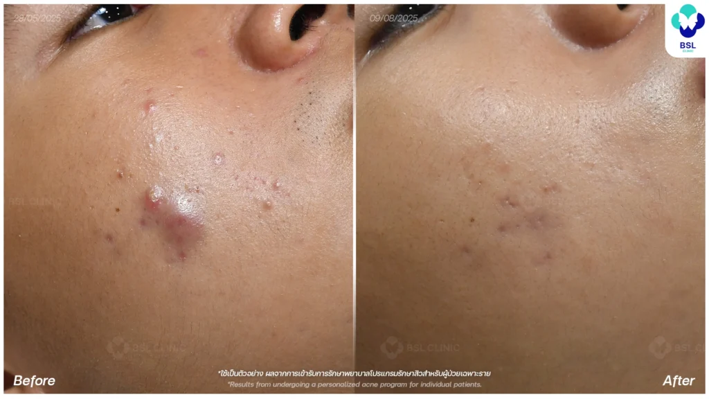 การดูแลผิว รีวิวผลการรักษาสิวอักเสบ