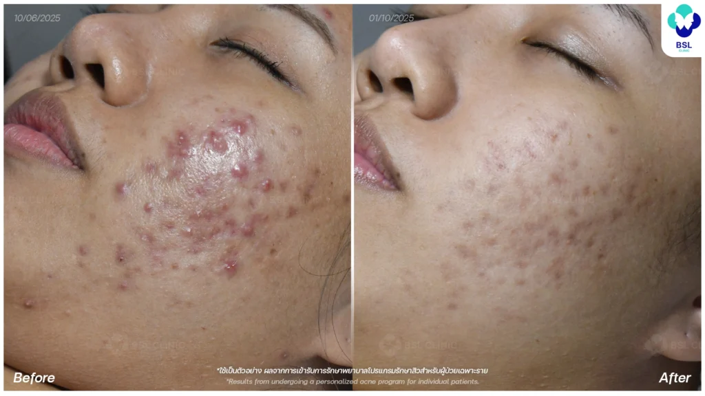 การดูแลผิว รีวิวผลการรักษาสิวอักเสบ