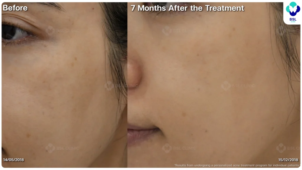 รีวิวรักษาสิว