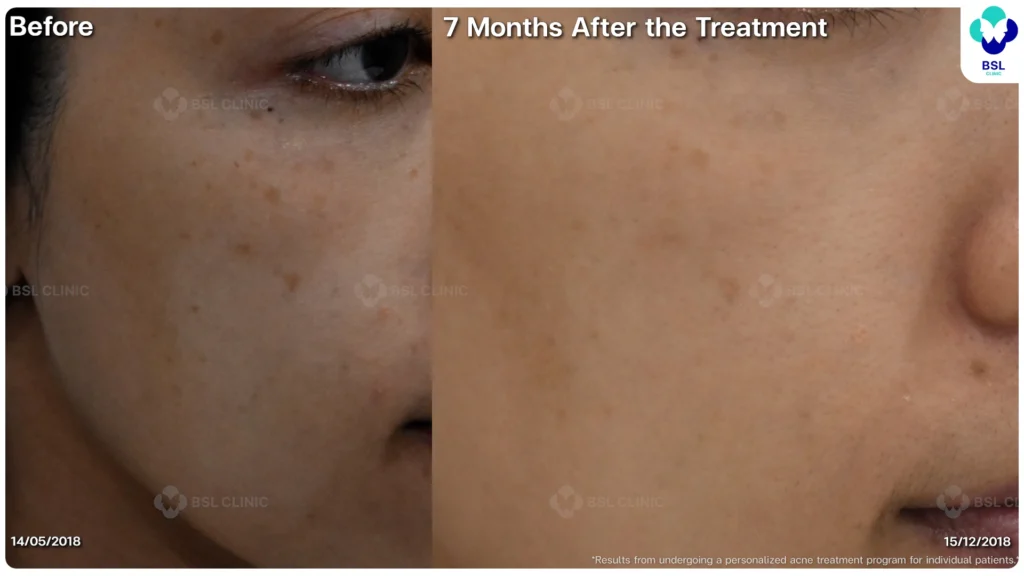 รีวิวรักษาสิว