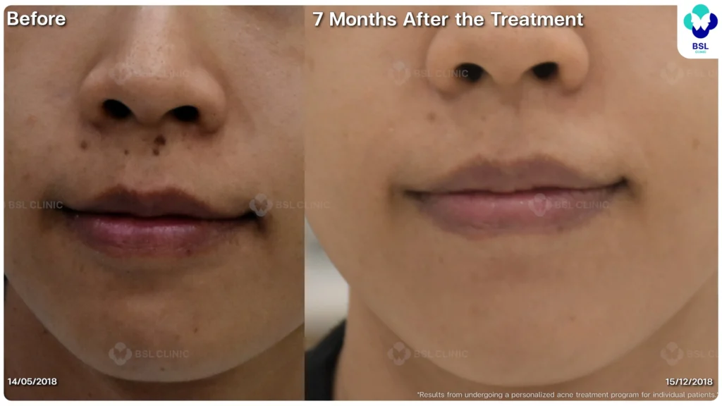 รีวิวรักษาสิว