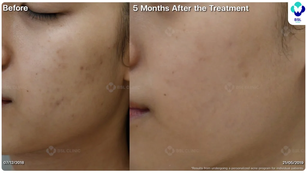 รีวิวรักษาสิว