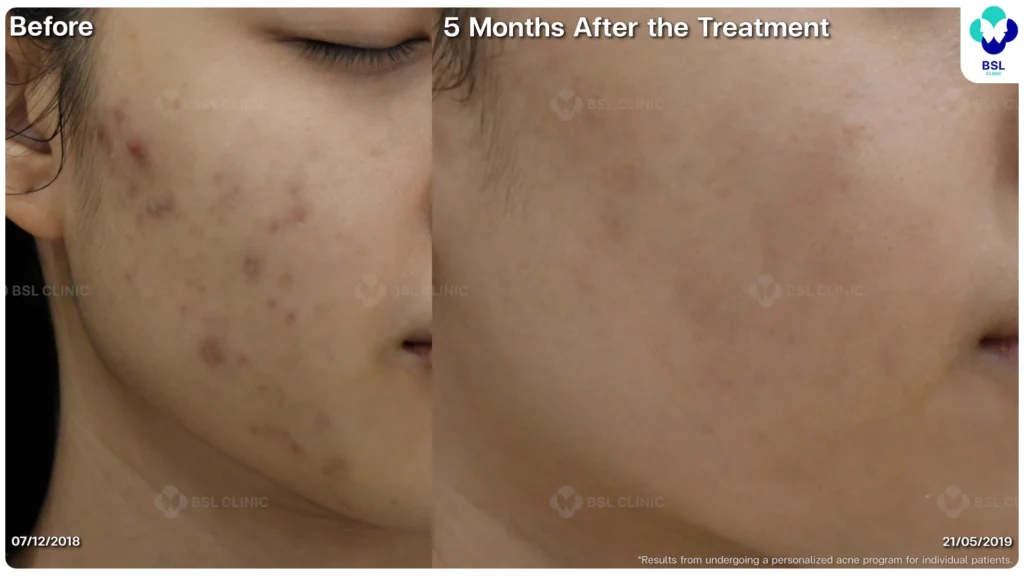 รีวิวรักษาสิว