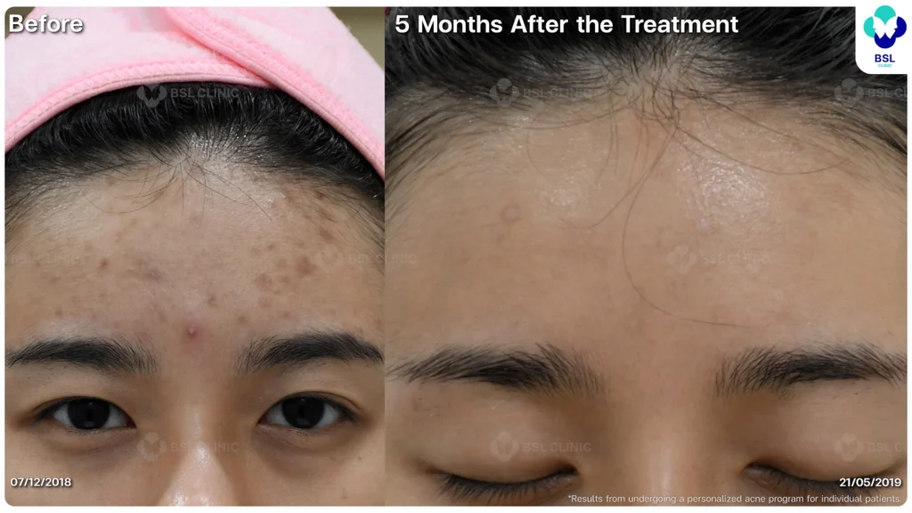 รีวิวรักษาสิว