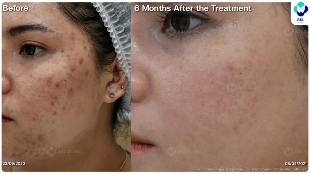 รีวิวรักษาสิว