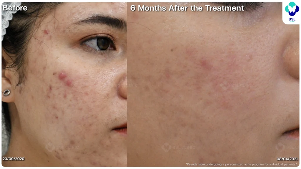 รีวิวรักษาสิว