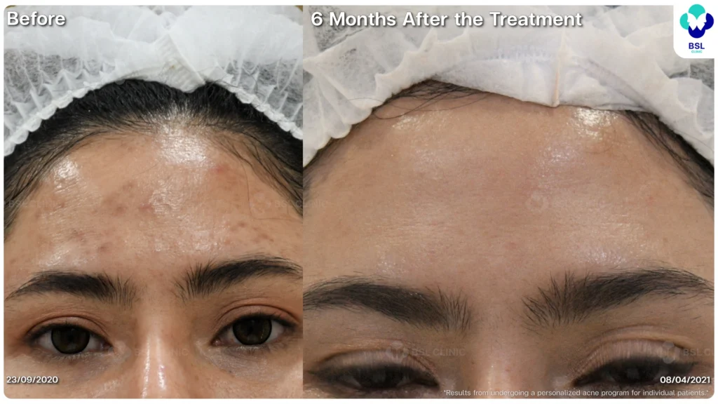 รีวิวรักษาสิว