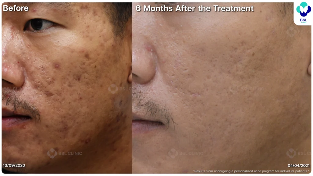 รีวิวรักษาสิว