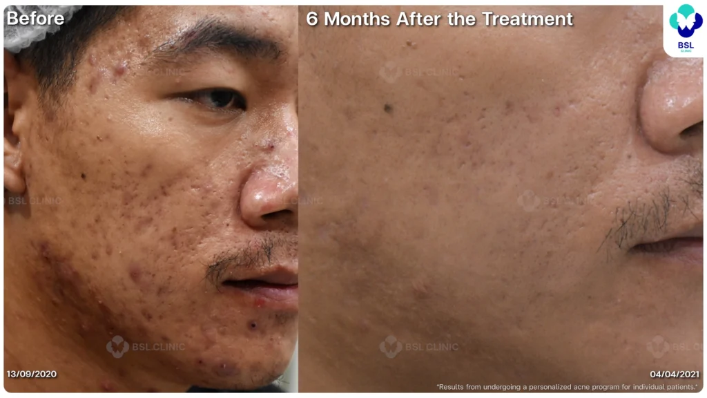 รีวิวรักษาสิว