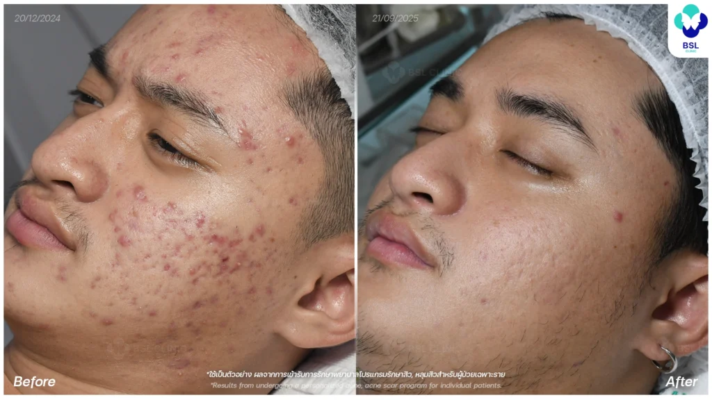 การดูแลผิว รีวิวผลการรักษาสิวอักเสบ